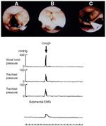 Figure 2 : An example of vocal cord closure pressure during cough. Unfortunately we are unable to provide accessible alternative text for this. If you require assistance to access this image, or to obtain a text description, please contact npg@nature.com