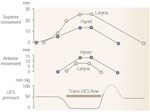 Figure 10 : Temporal relationship among UES pressure, trans-UES flow, and movement of the hyoid and larynx during 5-mL barium swallow. Unfortunately we are unable to provide accessible alternative text for this. If you require assistance to access this image, or to obtain a text description, please contact npg@nature.com