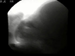 Video 3 : Abnormal swallowing resulting in delayed aspiration. (Occasional aspiration) Unfortunately we are unable to provide accessible alternative text for this. If you require assistance to access this image, or to obtain a text description, please contact npg@nature.com