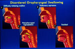 Figure 1 : Illustrations of disordered oropharyngeal swallowing. Unfortunately we are unable to provide accessible alternative text for this. If you require assistance to access this image, or to obtain a text description, please contact npg@nature.com