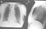 Figure 5 : Chest film of a patient with longstanding achalasia. Unfortunately we are unable to provide accessible alternative text for this. If you require assistance to access this image, or to obtain a text description, please contact npg@nature.com