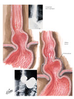 Figure 6 : The phrenoesophageal ligament at the gastroesophageal junction in normal and hiatal hernia. Unfortunately we are unable to provide accessible alternative text for this. If you require assistance to access this image, or to obtain a text description, please contact npg@nature.com