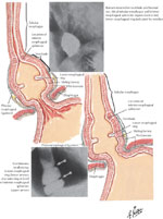Figure 7 : Attachment of phrenoesophageal ligand to lower esophageal sphincter. Unfortunately we are unable to provide accessible alternative text for this. If you require assistance to access this image, or to obtain a text description, please contact npg@nature.com