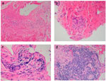 Figure 6 : Histopathology of achalasia. Unfortunately we are unable to provide accessible alternative text for this. If you require assistance to access this image, or to obtain a text description, please contact npg@nature.com