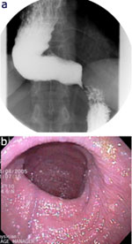 Figure 1 : a: Barium esophagram showing a dilated, tortuous esophagus and a |[ldquo]|bird's beak|[rdquo]| appearance of the lower esophageal sphincter (LES). Unfortunately we are unable to provide accessible alternative text for this. If you require assistance to access this image, or to obtain a text description, please contact npg@nature.com