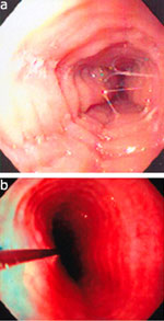 Figure 10 : Multiple esophageal rings. Unfortunately we are unable to provide accessible alternative text for this. If you require assistance to access this image, or to obtain a text description, please contact npg@nature.com