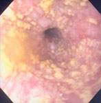 Figure 3 : Candida esophagitis in a patient with achalasia. Unfortunately we are unable to provide accessible alternative text for this. If you require assistance to access this image, or to obtain a text description, please contact npg@nature.com