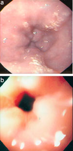 Figure 4 : Two examples of a puckered lower esophageal sphincter in patients with achalasia. Unfortunately we are unable to provide accessible alternative text for this. If you require assistance to access this image, or to obtain a text description, please contact npg@nature.com