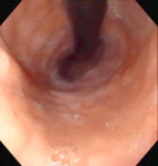 Figure 5 : Retroflexed view showing a patulous gastroesophageal junction in a patient with scleroderma. Unfortunately we are unable to provide accessible alternative text for this. If you require assistance to access this image, or to obtain a text description, please contact npg@nature.com