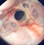 Figure 7 : Several epiphrenic diverticula in a patient with reflux esophagitis and a peptic stricture. Unfortunately we are unable to provide accessible alternative text for this. If you require assistance to access this image, or to obtain a text description, please contact npg@nature.com