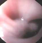 Figure 8 : Zenker's diverticulum. Unfortunately we are unable to provide accessible alternative text for this. If you require assistance to access this image, or to obtain a text description, please contact npg@nature.com