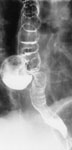 Figure 9 : Barium x-ray swallowing study showing a large mid-esophageal pulsion diverticulum. Unfortunately we are unable to provide accessible alternative text for this. If you require assistance to access this image, or to obtain a text description, please contact npg@nature.com