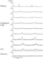 Figure 12 : Representative recording of esophageal motility from a patient with a nonspecific esophageal motor disorder. Unfortunately we are unable to provide accessible alternative text for this. If you require assistance to access this image, or to obtain a text description, please contact npg@nature.com