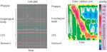 Figure 4 : An example of a normal esophageal response to a water swallow displayed as a conventional line plot (left panel) and as a colored topographical plot (right panel). Unfortunately we are unable to provide accessible alternative text for this. If you require assistance to access this image, or to obtain a text description, please contact npg@nature.com