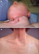 Figure 4 : Radial artery forearm free flap reconstruction of cervical esophagus. Unfortunately we are unable to provide accessible alternative text for this. If you require assistance to access this image, or to obtain a text description, please contact npg@nature.com