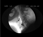 Video 2 : Example of videoswallow and concurrent manometric tracing from a patient with severe dysphagia secondary to lateral medullary infarction causing failed UES relaxation and marked pharyngeal weakness. Unfortunately we are unable to provide accessible alternative text for this. If you require assistance to access this image, or to obtain a text description, please contact npg@nature.com
