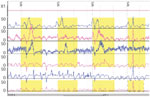 Figure 3 : Nonspecific esophageal motility disorder in a long-standing diabetic. Unfortunately we are unable to provide accessible alternative text for this. If you require assistance to access this image, or to obtain a text description, please contact npg@nature.com