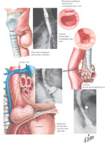 Figure 1 : Illustration and radiological appearance of Zenker's mid esophageal and epiphrenic esophageal diverticula. Unfortunately we are unable to provide accessible alternative text for this. If you require assistance to access this image, or to obtain a text description, please contact npg@nature.com
