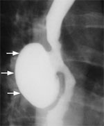 Figure 3 : Barium swallow of a patient with midthoracic or traction diverticulum. Unfortunately we are unable to provide accessible alternative text for this. If you require assistance to access this image, or to obtain a text description, please contact npg@nature.com