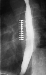 Figure 4 : Barium swallow of a patient with intramural pseudodiverticulosis. Unfortunately we are unable to provide accessible alternative text for this. If you require assistance to access this image, or to obtain a text description, please contact npg@nature.com