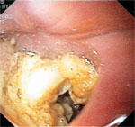 Figure 5 : Endoscopic appearance of Zenker's diverticulum. Unfortunately we are unable to provide accessible alternative text for this. If you require assistance to access this image, or to obtain a text description, please contact npg@nature.com