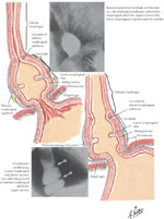 Figure 7 : Illustration of A ring (muscular ring) and B ring (Schatzki mucosal ring) in the lower esophagus. Unfortunately we are unable to provide accessible alternative text for this. If you require assistance to access this image, or to obtain a text description, please contact npg@nature.com
