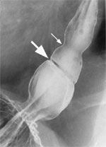 Figure 8 : Barium swallow of a patient with A and B rings of the distal esophagus. Unfortunately we are unable to provide accessible alternative text for this. If you require assistance to access this image, or to obtain a text description, please contact npg@nature.com