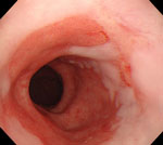 Figure 1 : Endoscopic photograph of Barrett's esophagus. Unfortunately we are unable to provide accessible alternative text for this. If you require assistance to access this image, or to obtain a text description, please contact npg@nature.com