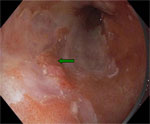 Figure 1 : Endoscopic image of Barrett's adenocarcinoma using high-resolution endoscopy. Unfortunately we are unable to provide accessible alternative text for this. If you require assistance to access this image, or to obtain a text description, please contact npg@nature.com