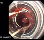 Figure 5 : Endoscopic mucosal resection of early Barrett's adenocarcinoma using the banding technique. Unfortunately we are unable to provide accessible alternative text for this. If you require assistance to access this image, or to obtain a text description, please contact npg@nature.com