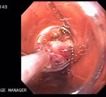 Figure 8 : Specimen retrieval post|[ndash]|endoscopic mucosal resection using a net basket. Unfortunately we are unable to provide accessible alternative text for this. If you require assistance to access this image, or to obtain a text description, please contact npg@nature.com