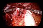 Figure 11 : Intraoperative image of a laparoscopic fundoplication. Unfortunately we are unable to provide accessible alternative text for this. If you require assistance to access this image, or to obtain a text description, please contact npg@nature.com