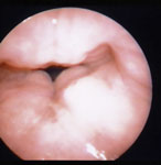 Figure 5 : An extraordinary degree of diffuse laryngeal edema is seen in an individual with more than 80 episodes of LPR on pH testing. Unfortunately we are unable to provide accessible alternative text for this. If you require assistance to access this image, or to obtain a text description, please contact npg@nature.com