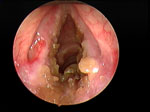 Figure 8 : Crusting granulation tissue seen in the larynx and subglottis of a patient with Wegener's granulomatosis. Unfortunately we are unable to provide accessible alternative text for this. If you require assistance to access this image, or to obtain a text description, please contact npg@nature.com