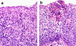 Figure 1 : Histologic features of eosinophilic esophagitis. Unfortunately we are unable to provide accessible alternative text for this. If you require assistance to access this image, or to obtain a text description, please contact npg@nature.com
