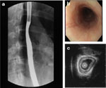 Figure 3 : Radiographic and endoscopic studies from an 18-year-old woman with a longstanding history of dysphagia that began in early childhood. Unfortunately we are unable to provide accessible alternative text for this. If you require assistance to access this image, or to obtain a text description, please contact npg@nature.com