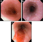 Figure 4 : Endoscopic features of eosinophilic esophagitis. Unfortunately we are unable to provide accessible alternative text for this. If you require assistance to access this image, or to obtain a text description, please contact npg@nature.com