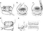 Figure 11 : Subperichondrial cricoidectomy for definitive separation of the upper alimentary and respiratory passages. Unfortunately we are unable to provide accessible alternative text for this. If you require assistance to access this image, or to obtain a text description, please contact npg@nature.com