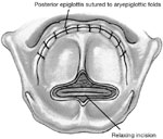Figure 3 : Supraglottic closure with epiglottic flap incorporating relaxing incision of epiglottis. Unfortunately we are unable to provide accessible alternative text for this. If you require assistance to access this image, or to obtain a text description, please contact npg@nature.com