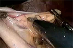 Video 1 : Short gastric dissection. Unfortunately we are unable to provide accessible alternative text for this. If you require assistance to access this image, or to obtain a text description, please contact npg@nature.com