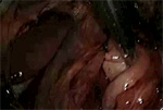 Video 4 : Toupet fundoplication. Unfortunately we are unable to provide accessible alternative text for this. If you require assistance to access this image, or to obtain a text description, please contact npg@nature.com
