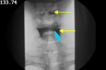 Figure 5 : Evidence for barium stasis in valleculae and pyriforms (yellow thin arrows). Unfortunately we are unable to provide accessible alternative text for this. If you require assistance to access this image, or to obtain a text description, please contact npg@nature.com