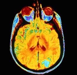 brain cancer MRI