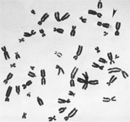 This micrograph shows 46 black, X-shaped, metaphase chromosomes against a white background. An arrow points to the end of the long arm of the X chromosome where there is a constricted site. Due to the constricted site, the end of the chromosome appears detached, giving the X chromosome a fragile appearance.