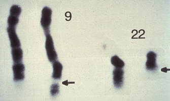 A micrograph shows four, dark, banded chromosomes on a white background. On the left are two copies of chromosome 9, and on the right are two copies of chromosomes 22. Two arrows indicate the reciprocal translocation of the long arms of chromosomes 9 and 22, creating a longer version of chromosome 9 and a shorter version of chromosome 22, which is called the Philadelphia chromosome.