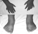 Two black-and-white photographs show human hands (top panel) or human feet (bottom panel) with extra digits. In panel A, a pair of hands is shown palms-down on a white sheet. A sixth finger is present to the outside of the pinky finger on both the left and right hands and is significantly shorter compared to the other digits. In panel B, a pair of feet is shown standing on a white sheet. A sixth toe is present to the outside of the little toe on both the left and right feet.