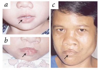 A series of photographs show patients suffering from Van der Woude syndrome. Panel A shows a close-up view of a young child’s lower facial features. An arrow points to a single repaired depression, or pit, in the child’s lower lip. Panel B also shows a close-up view of a child’s lower facial features; the child’s upper lip is indented in two places. An arrow points to a single pit on the child’s lower lip. Panel C shows a full-facial view of an adult man’s face. The man’s upper lip is indented in two places. An arrow points to pits on the man’s lower lip.
