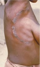 A ringworm infection is evident on a woman's torso. This infection is caused by the fungus <i>Trichophyton rubrum</i>, found in soils.