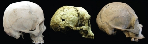 The LB1 cranium (center) compared to skulls of a modern human with endemic hypothyroidism (left) and a modern human showing microcephaly (right).