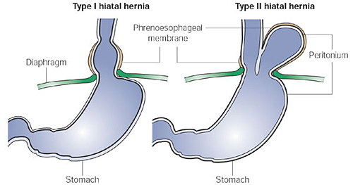paraesophgeal hiatus hernia